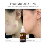 Oily & Acne Bundle